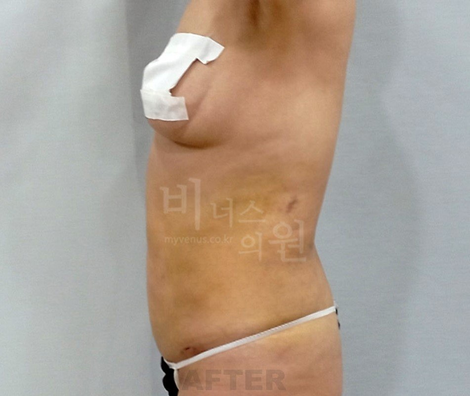 복부 지방흡입 수술 후 측면
