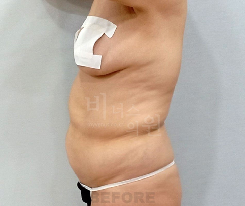 복부 지방흡입 수술 전 측면