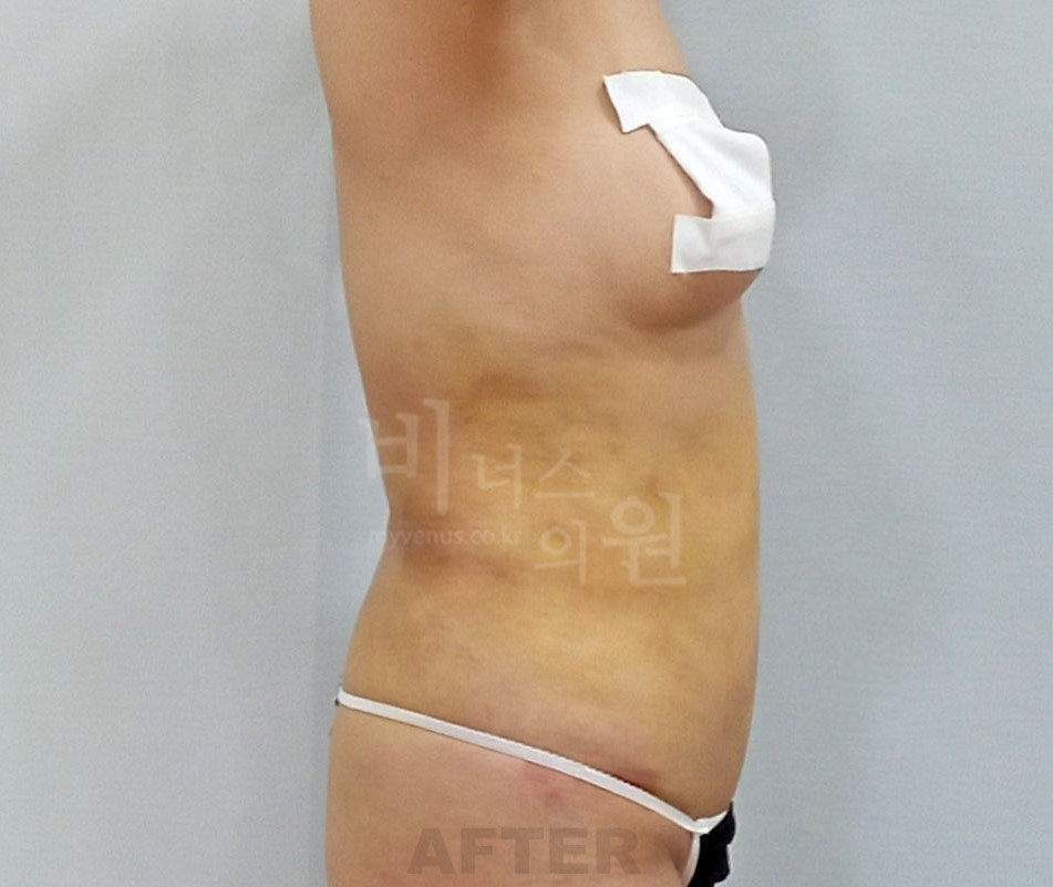 복부 지방흡입 수술 후 측면2