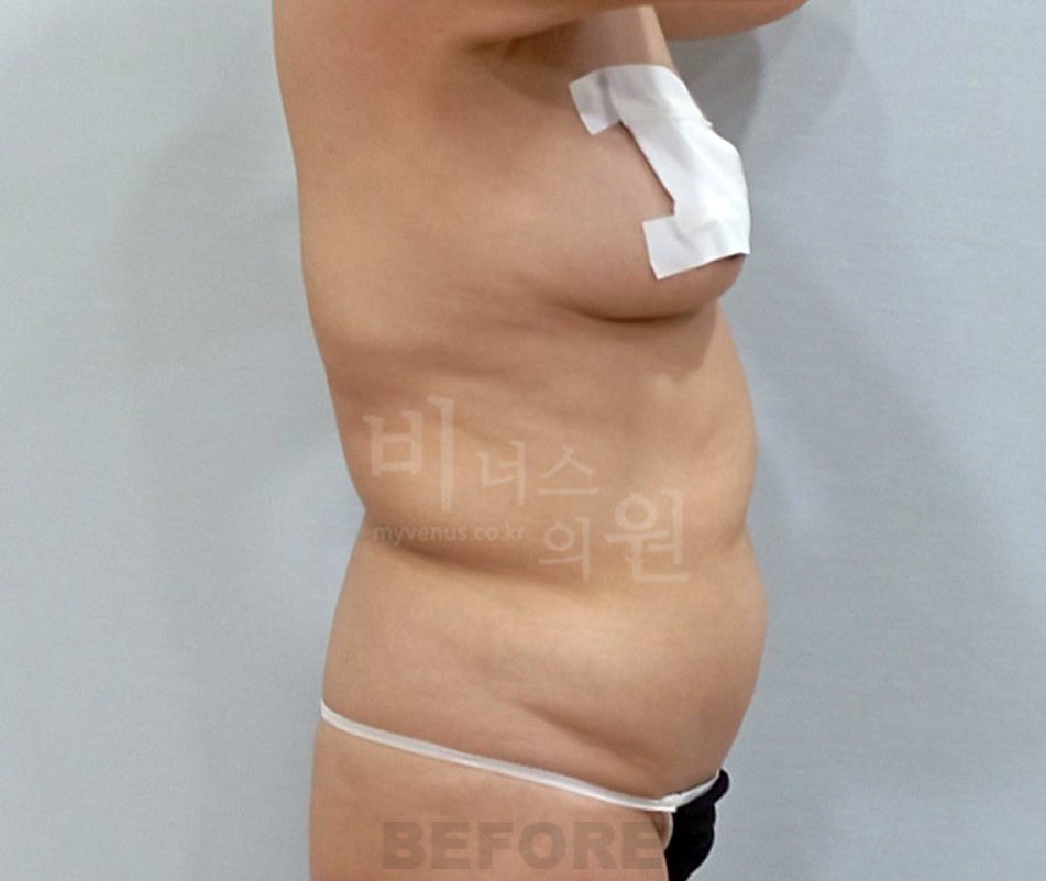 복부 지방흡입 수술 전 측면2
