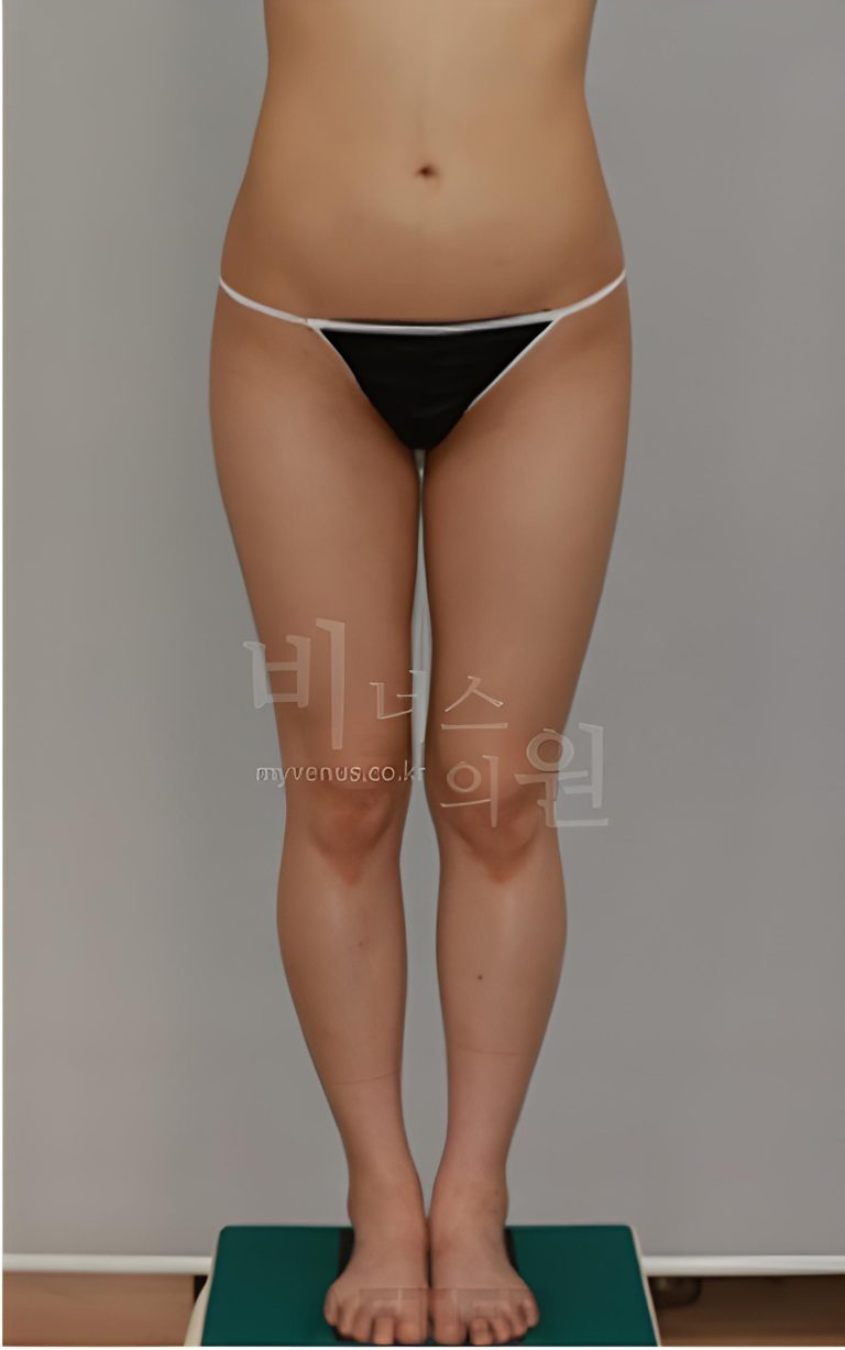 복부와 엉덩이를 같이 수술하면 어떻게 달라지나요? — 조합 수술 범위 선택 가이드