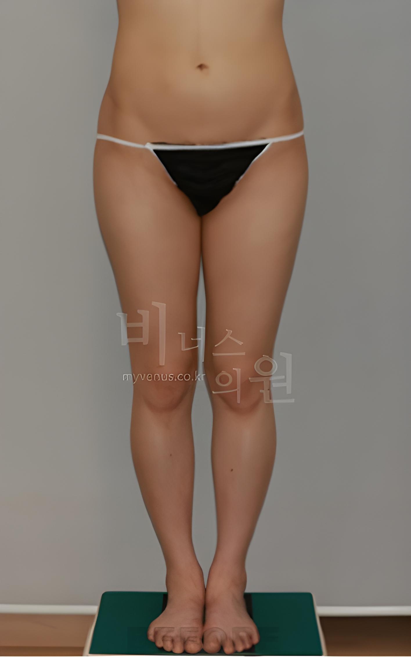 복부 엉덩이 볼륨업 지방흡입 수술 전 정면