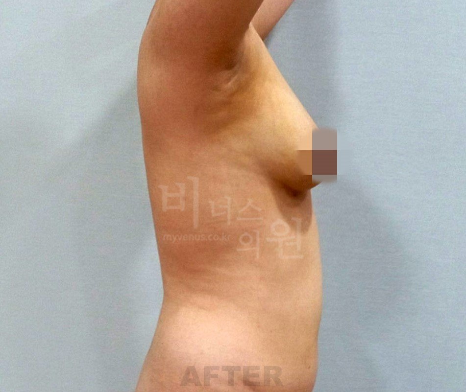 가슴축소 전후 10