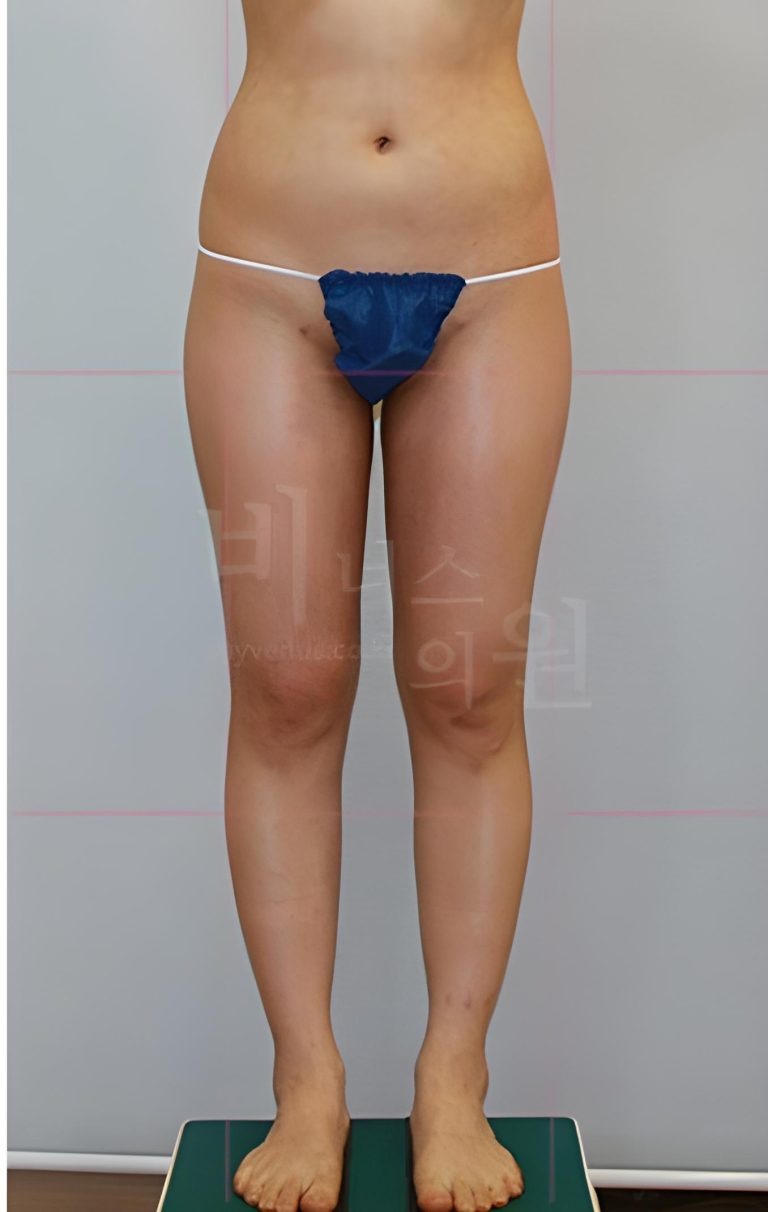 허벅지 지방흡입 비용, 무엇이 가격을 결정할까? 현명한 선택 가이드
