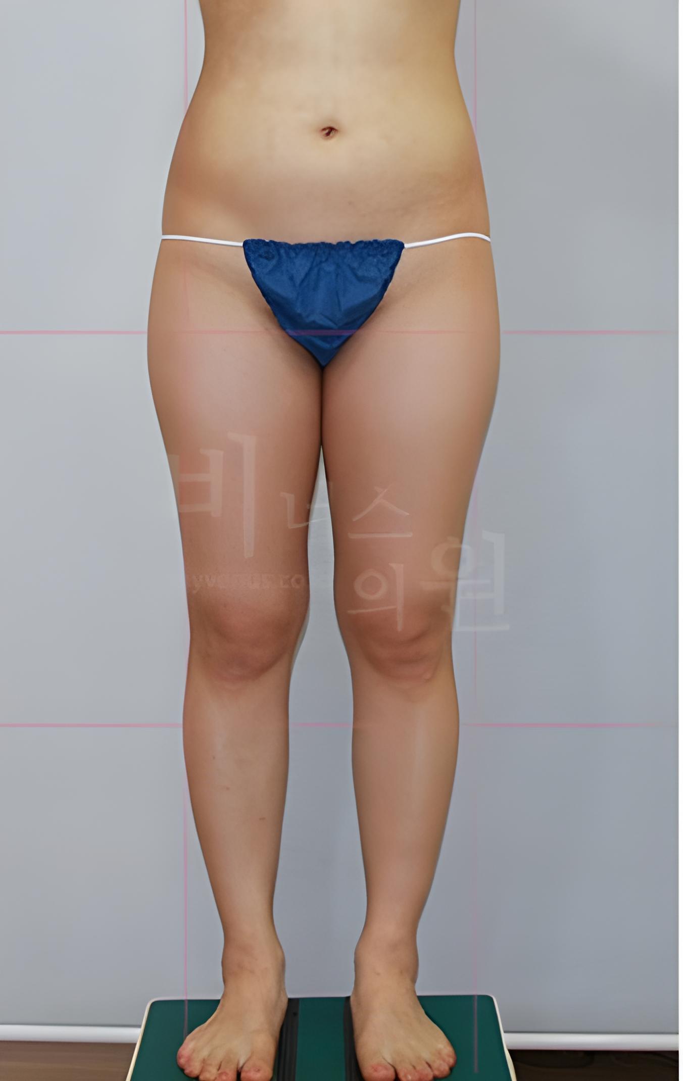 허벅지 맥시머C 지방흡입 수술 전 정면