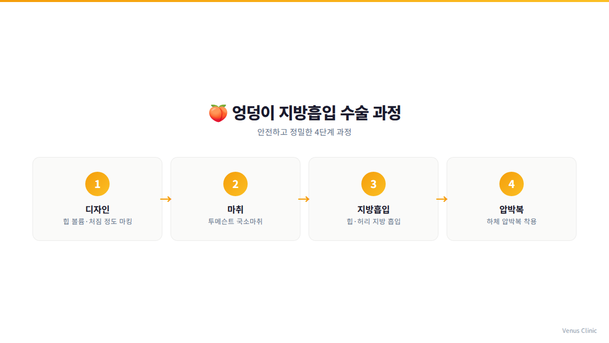 엉덩이 지방흡입 수술 과정 4단계 인포그래픽