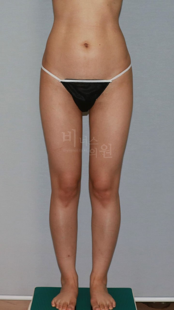 엉덩이지방흡입, 힙·엉덩이·허벅지 어디까지 해야 효과가 좋을까? 세트 수술 범위 결정 가이드