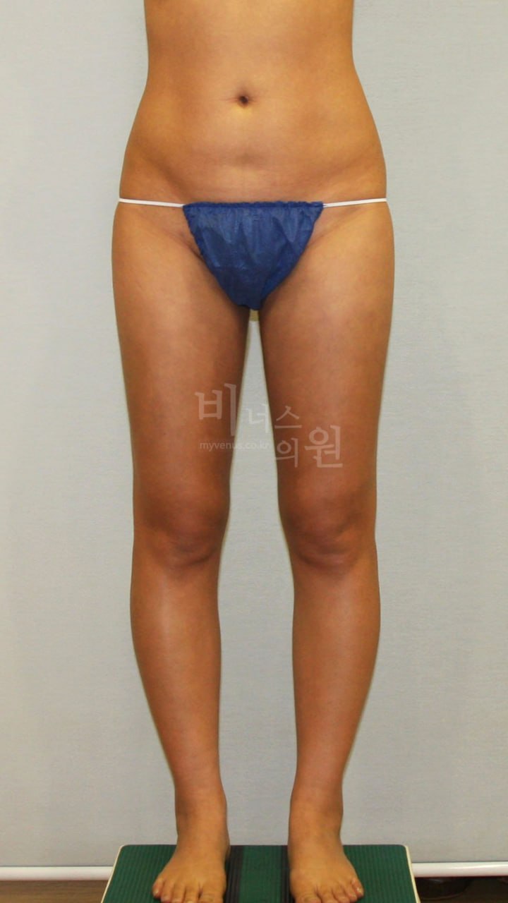 허벅지 지방흡입, 다이어트와 뭐가 다른가? 비용·선택 기준 완전 가이드