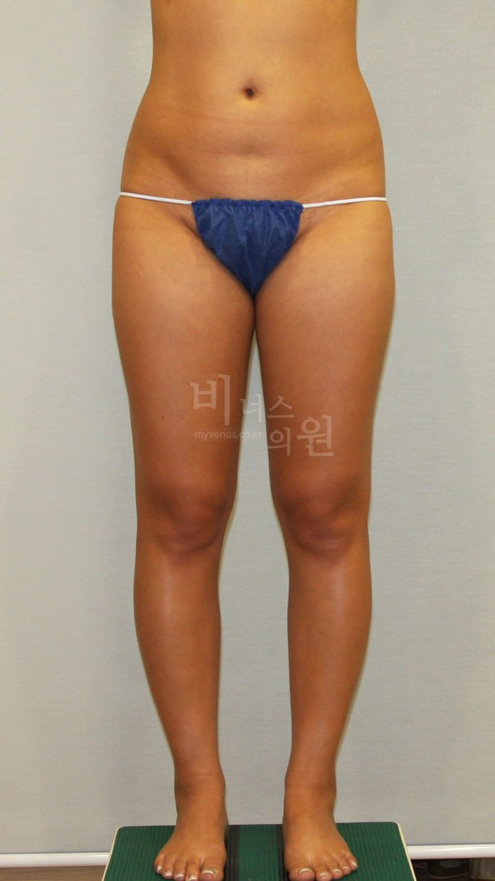 허벅지 지방흡입 수술 전 정면 — 부천 비너스의원