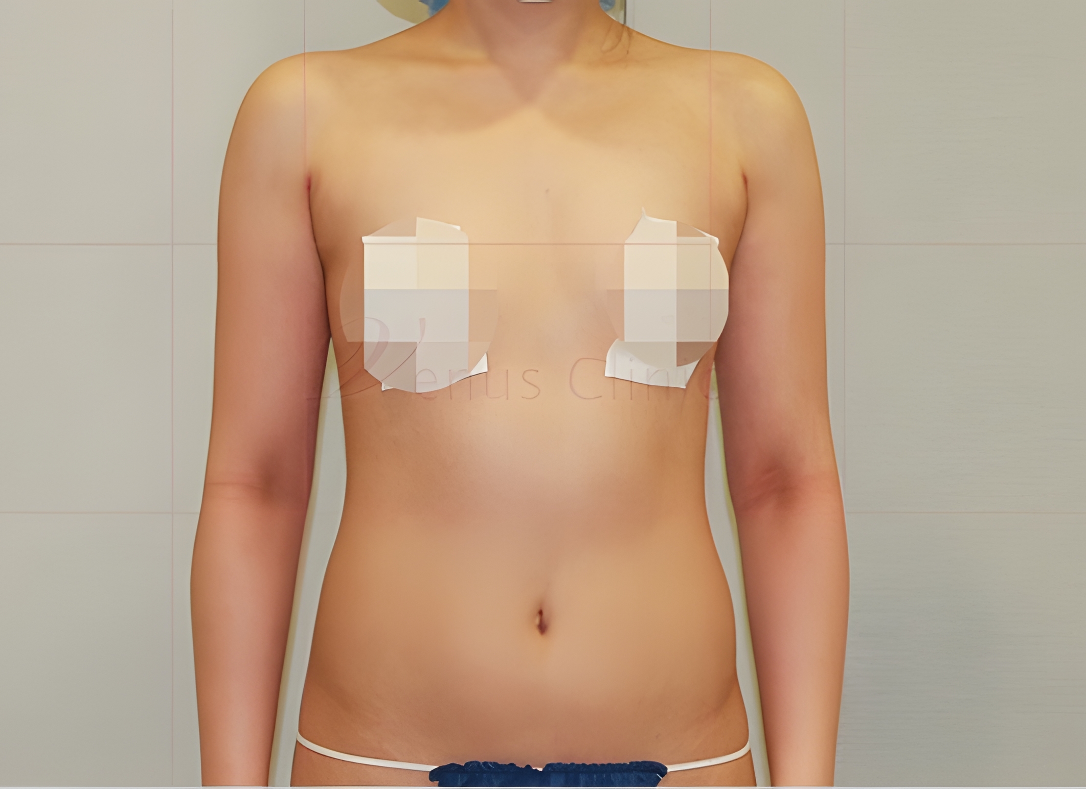 복부 지방흡입 수술 후 — 흉복부 원통형 정면 라인 개선