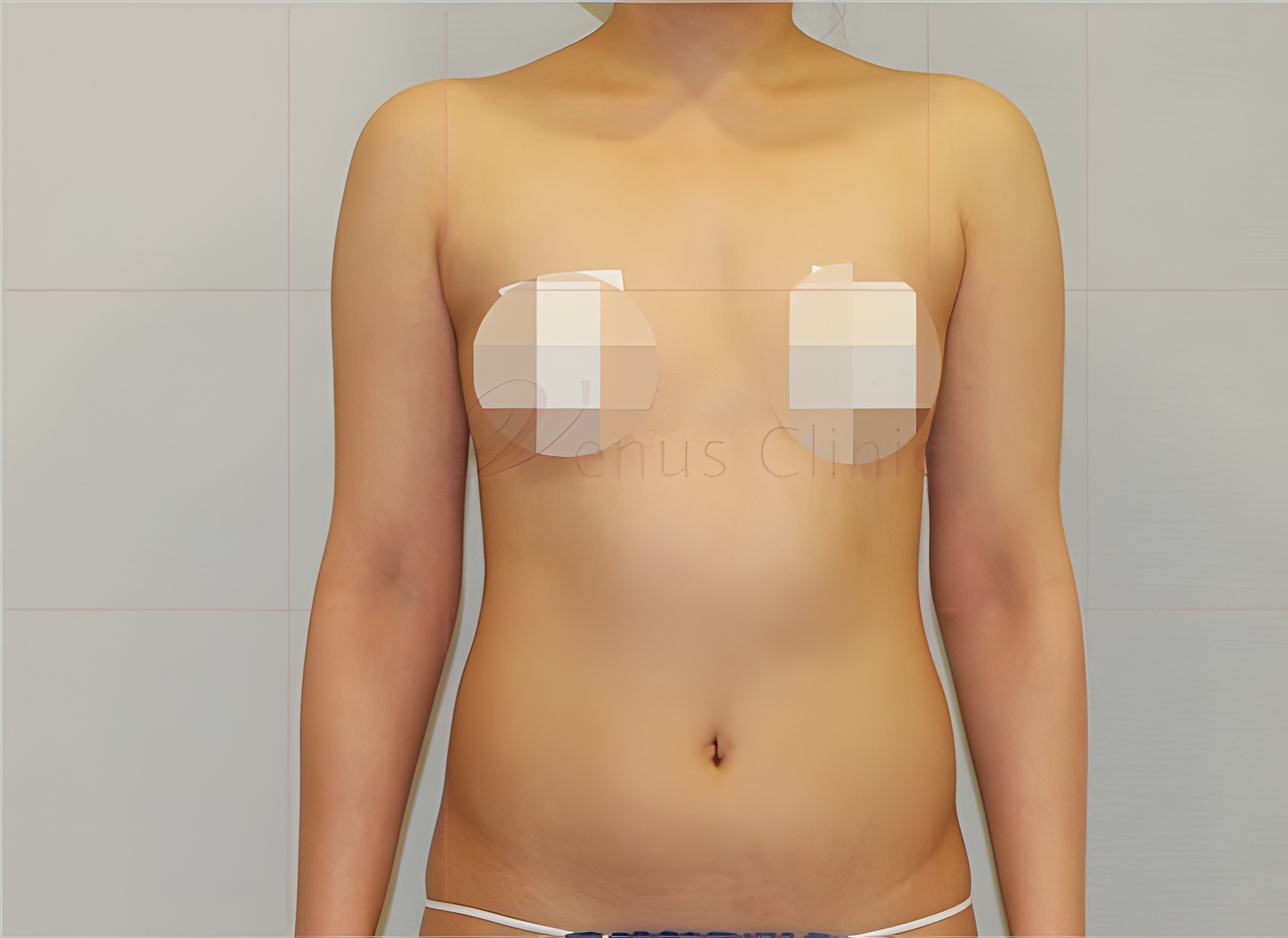 복부 지방흡입 수술 전 — 흉복부 원통형 정면