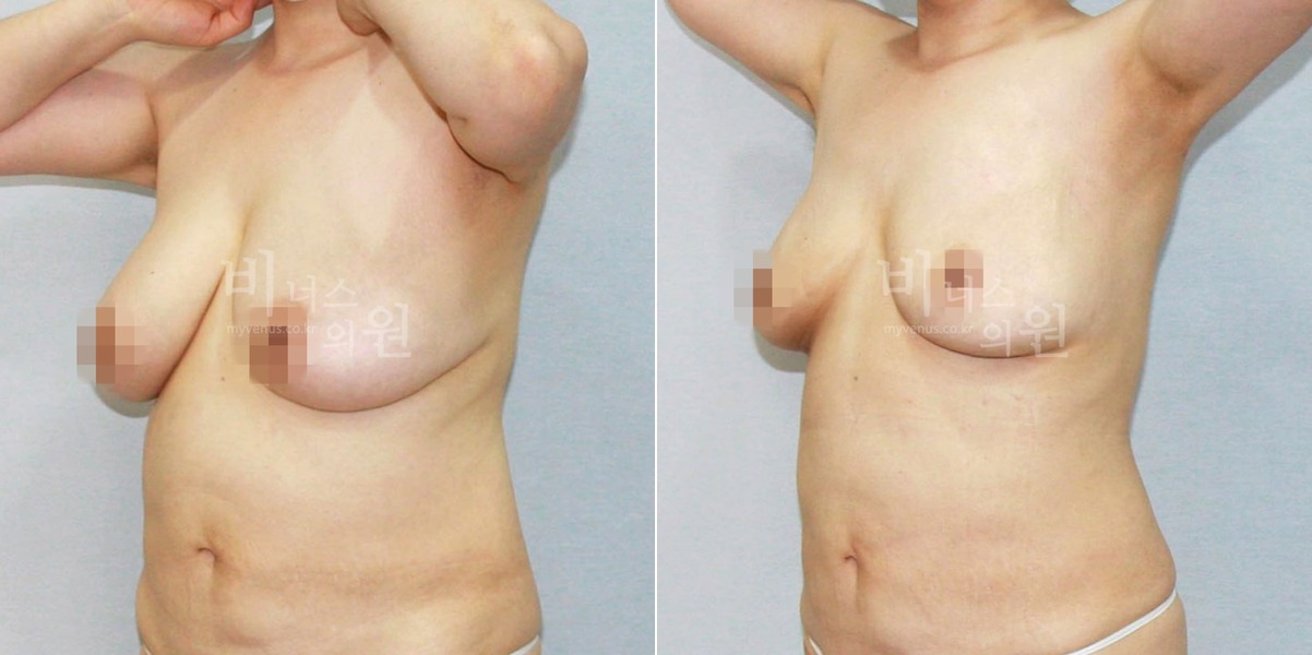 가슴축소 지방흡입 수술 전후 45도 측면 비교 — 비너스의원