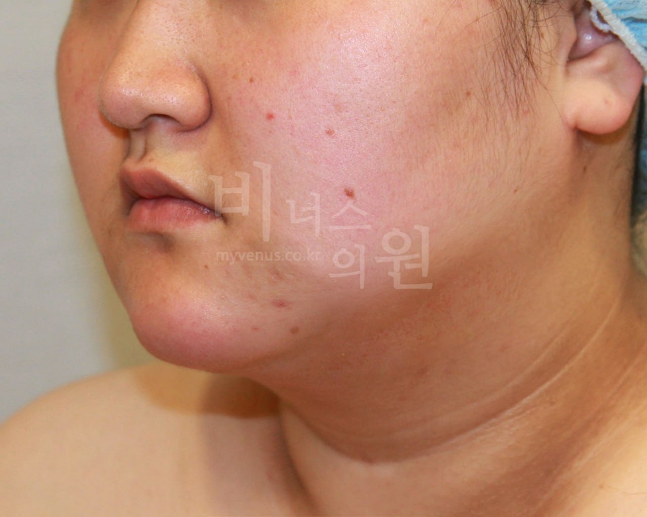 얼굴 이중턱 지방흡입 수술 후 우측 45도 비너스의원