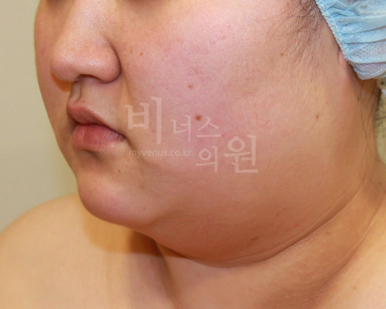 얼굴 이중턱 지방흡입 수술 전 우측 45도 비너스의원
