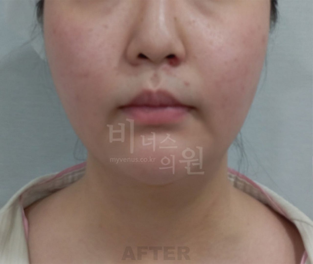 턱지방흡입 수술 후 정면 비너스의원