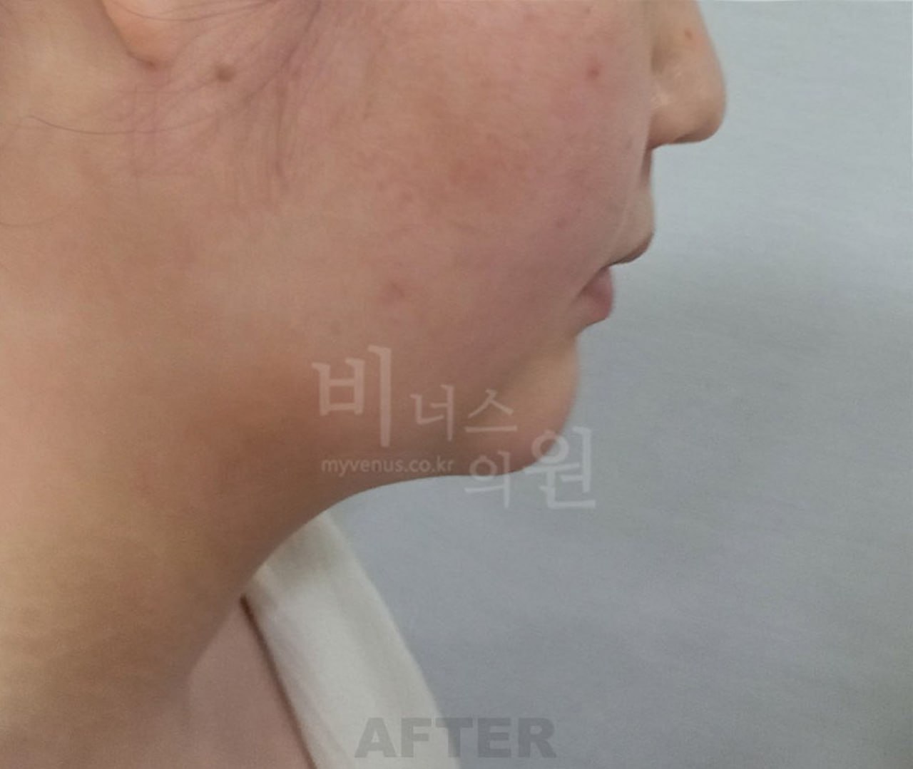 턱지방흡입 수술 후 왼측면 비너스의원
