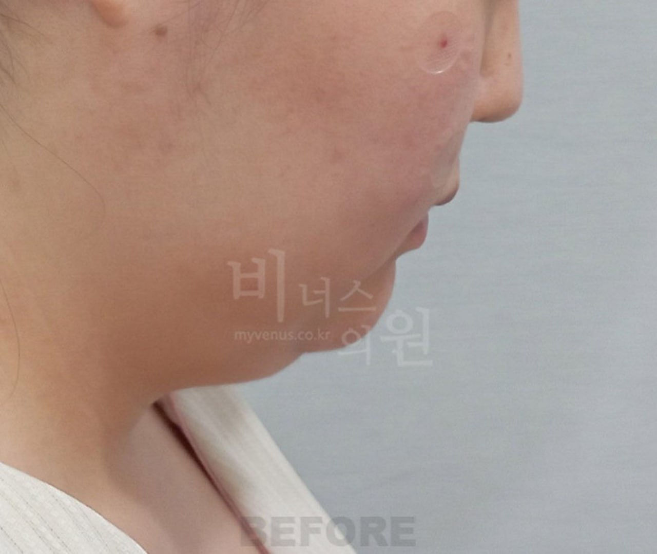 턱지방흡입 수술 전 왼측면 비너스의원
