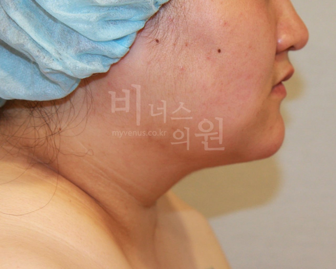 얼굴 이중턱 지방흡입 수술 후 왼측면 비너스의원