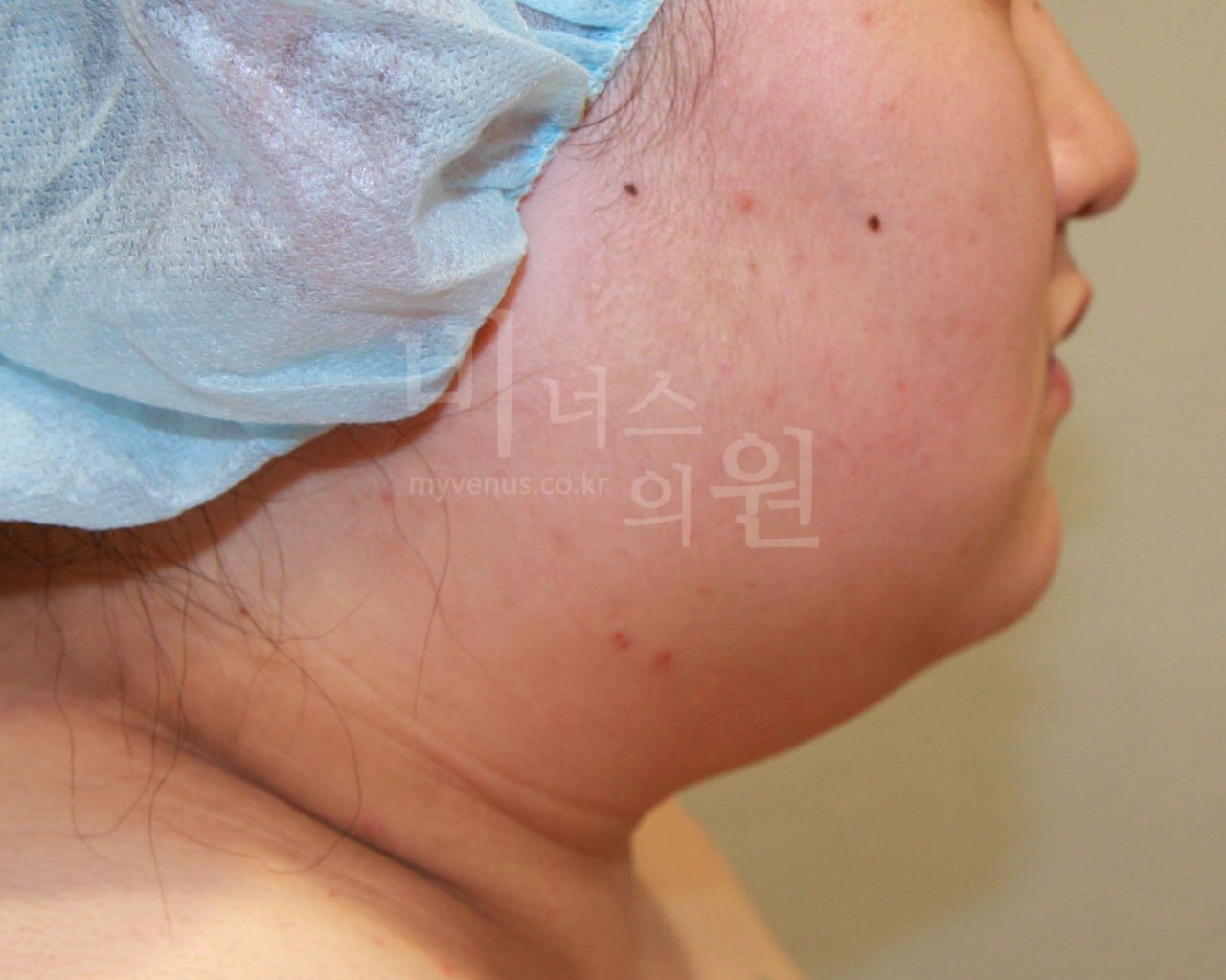 얼굴 이중턱 지방흡입 수술 전 왼측면 비너스의원
