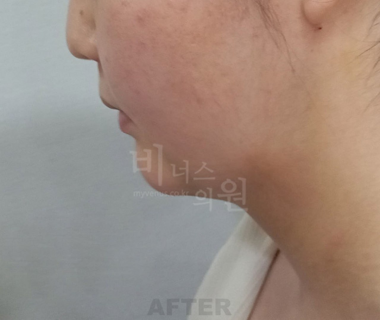 턱지방흡입 수술 후 우측면 비너스의원