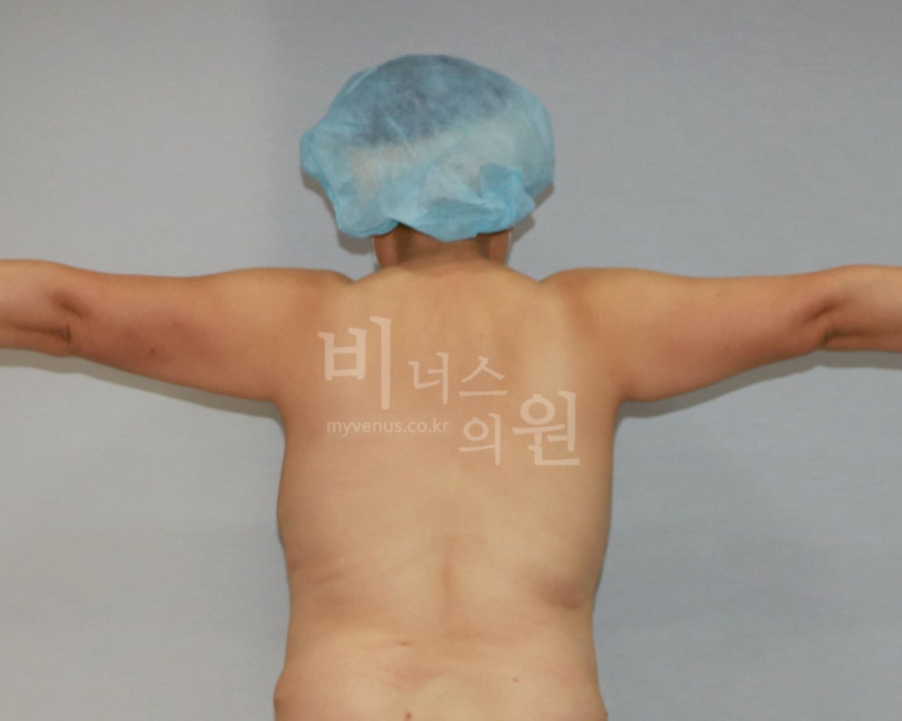 수술 전 — 후면(팔 수평)