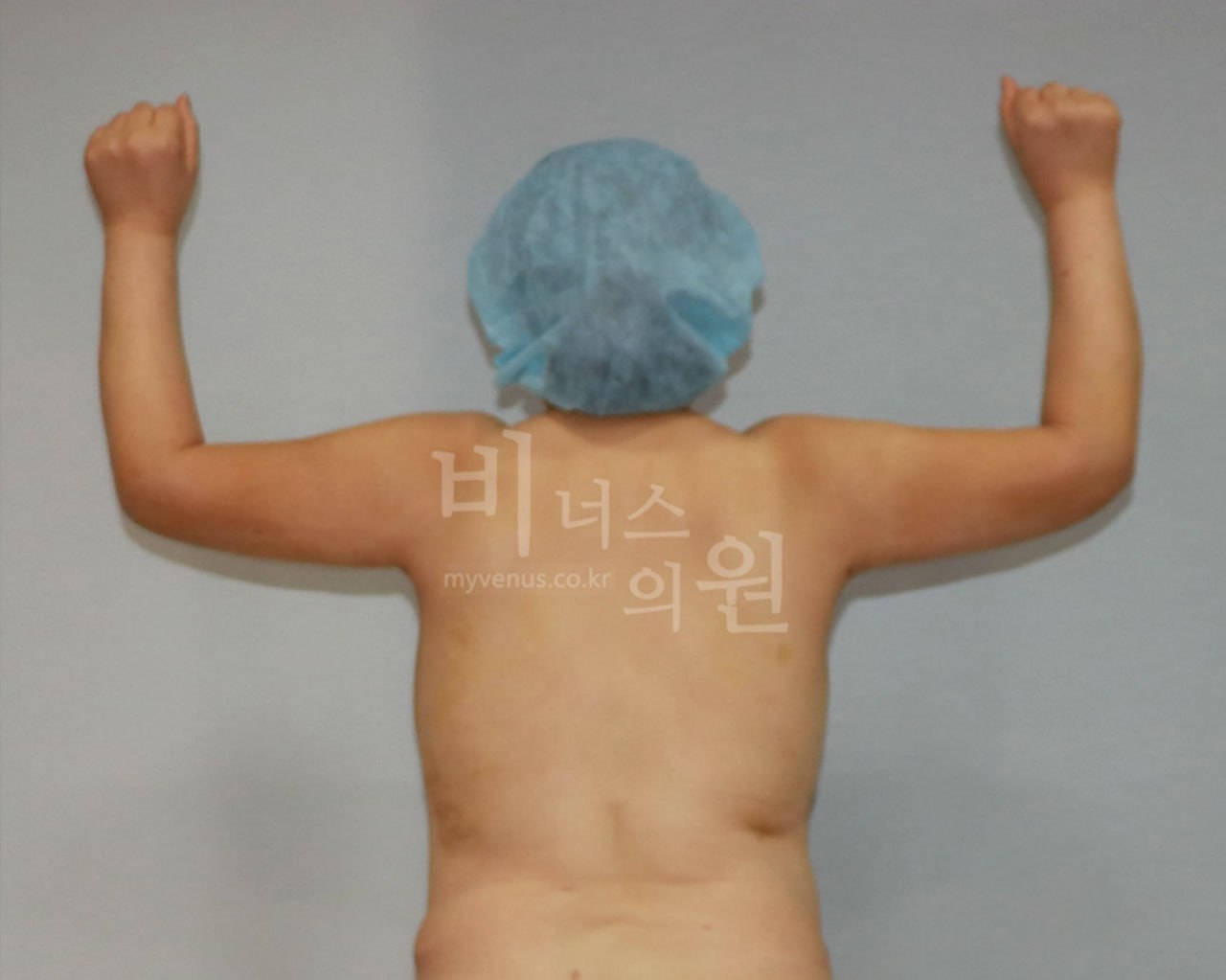 수술 후 — 후면(팔 위로)