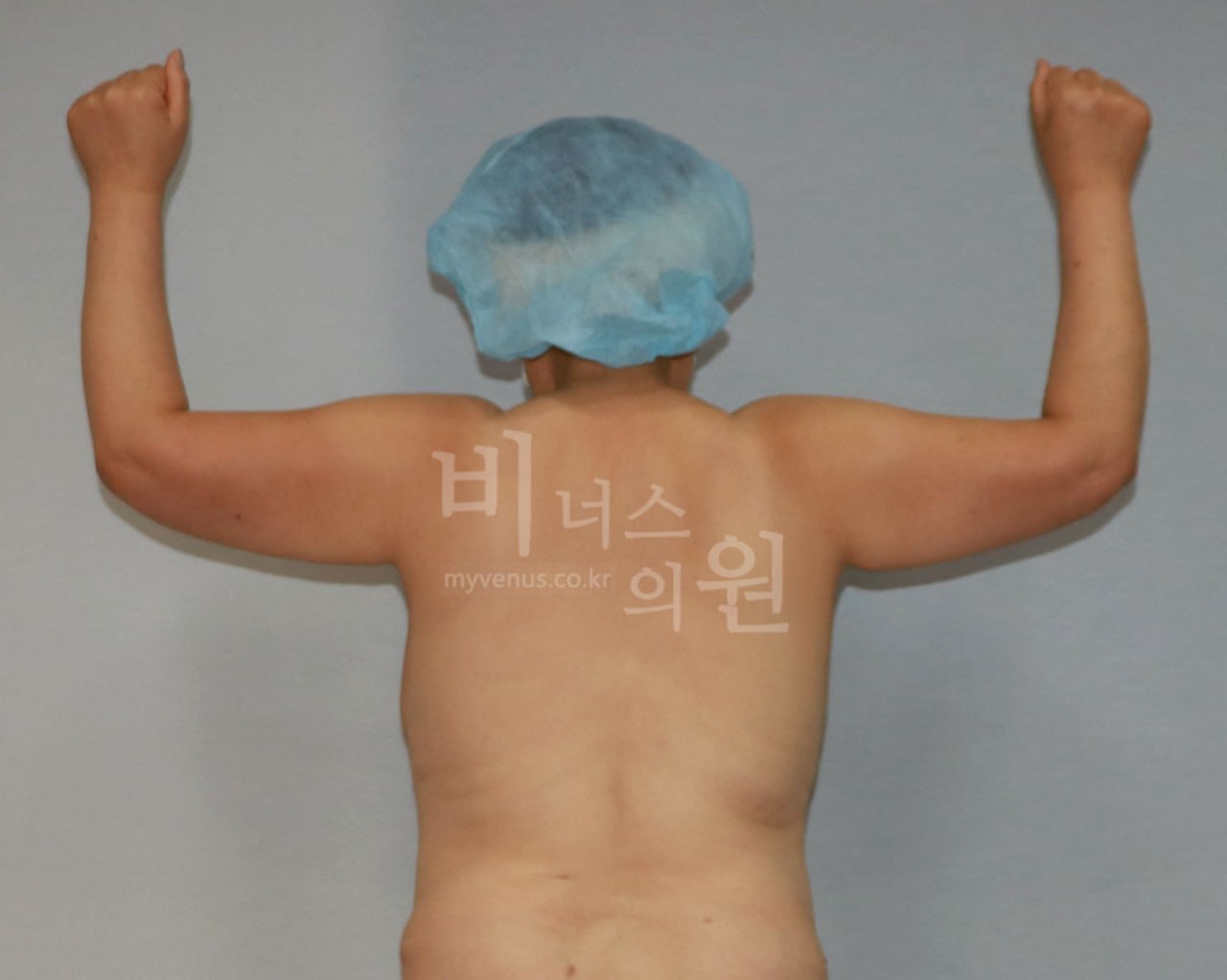 수술 전 — 후면(팔 위로)