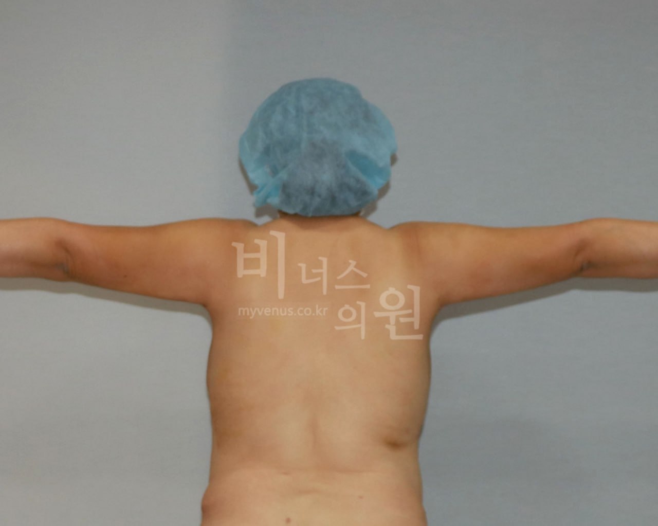 수술 후 — 후면(팔 수평)