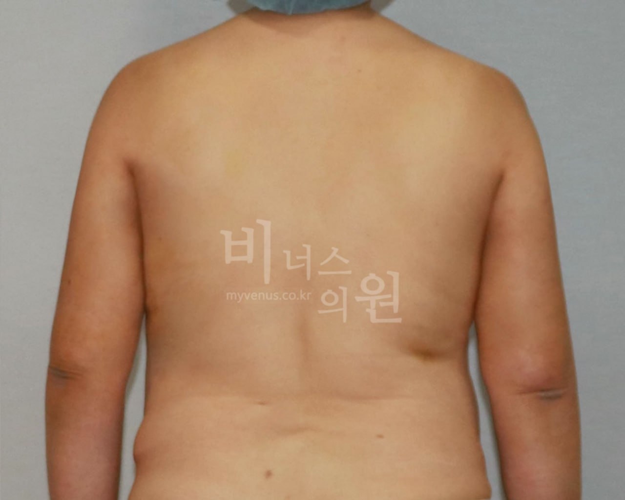 수술 후 — 후면(팔 내림)