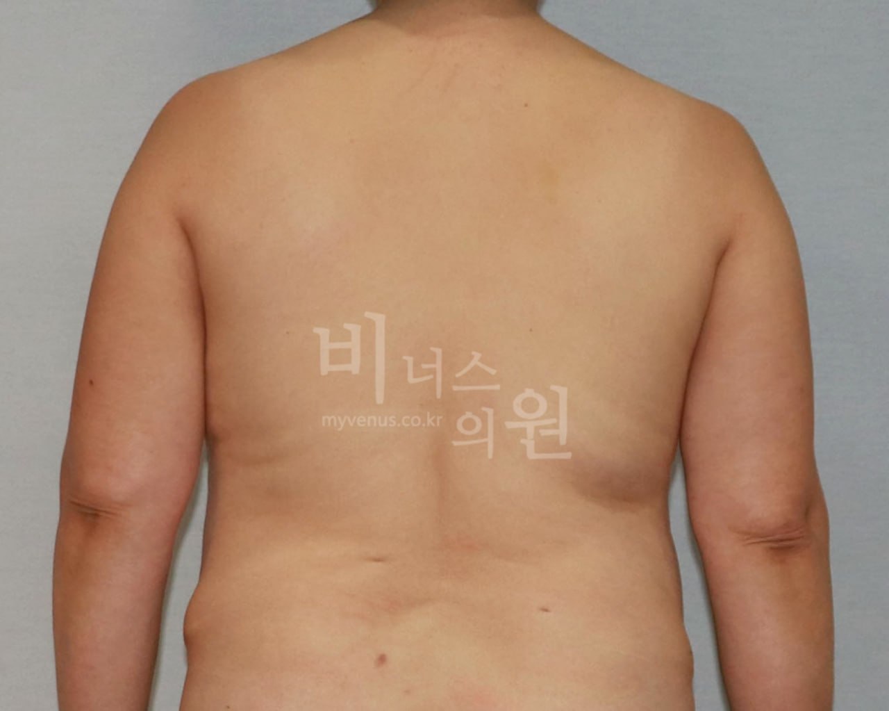 수술 전 — 후면(팔 내림)
