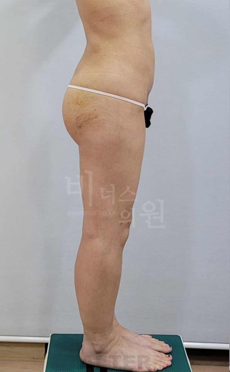 엉덩이축소 지방흡입 수술 후 왼측면 비너스의원