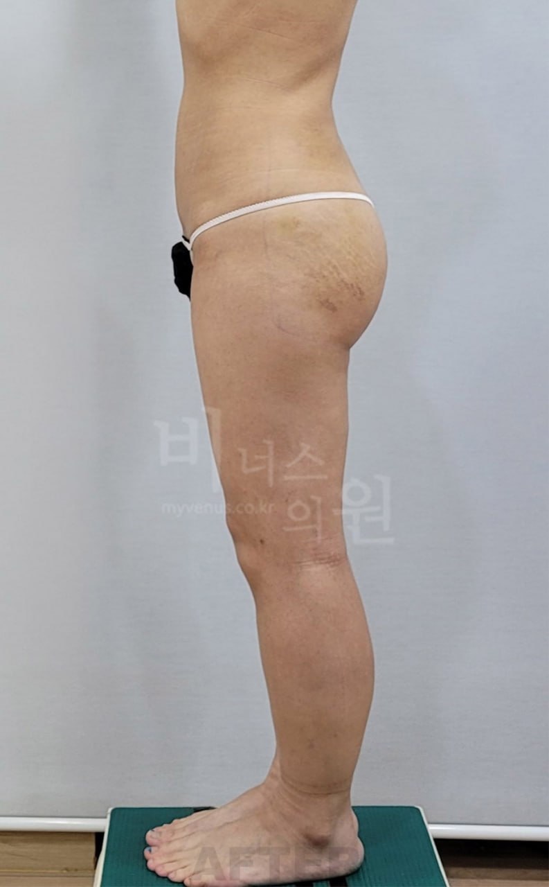 엉덩이축소 지방흡입 수술 후 우측면 비너스의원