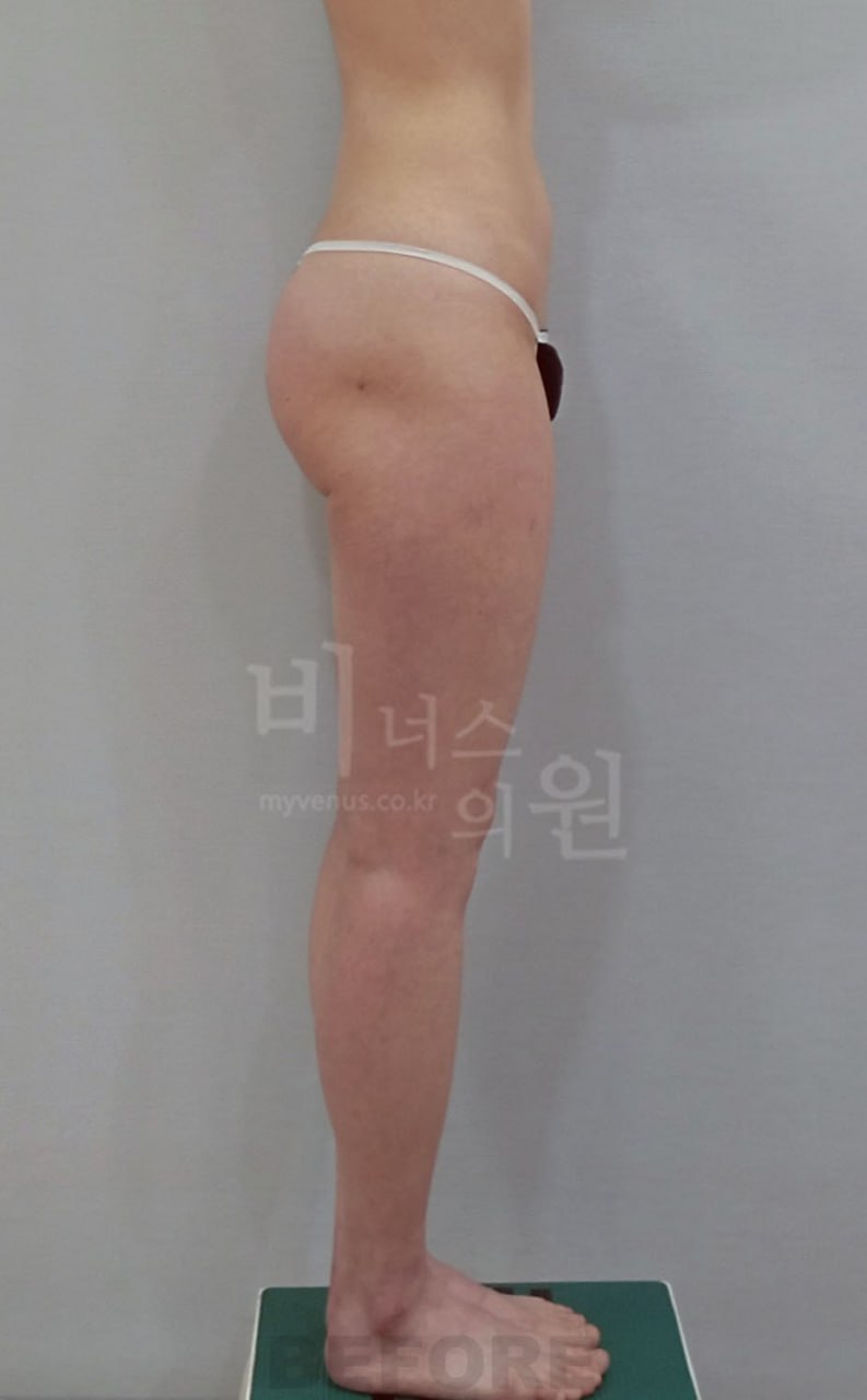 엉덩이볼륨업 지방흡입 수술 전 좌측면 비너스의원