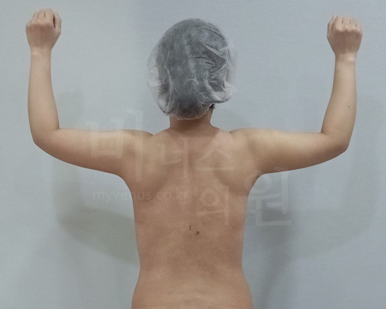 팔뚝지방흡입 수술 전 후면 팔올림 비너스의원