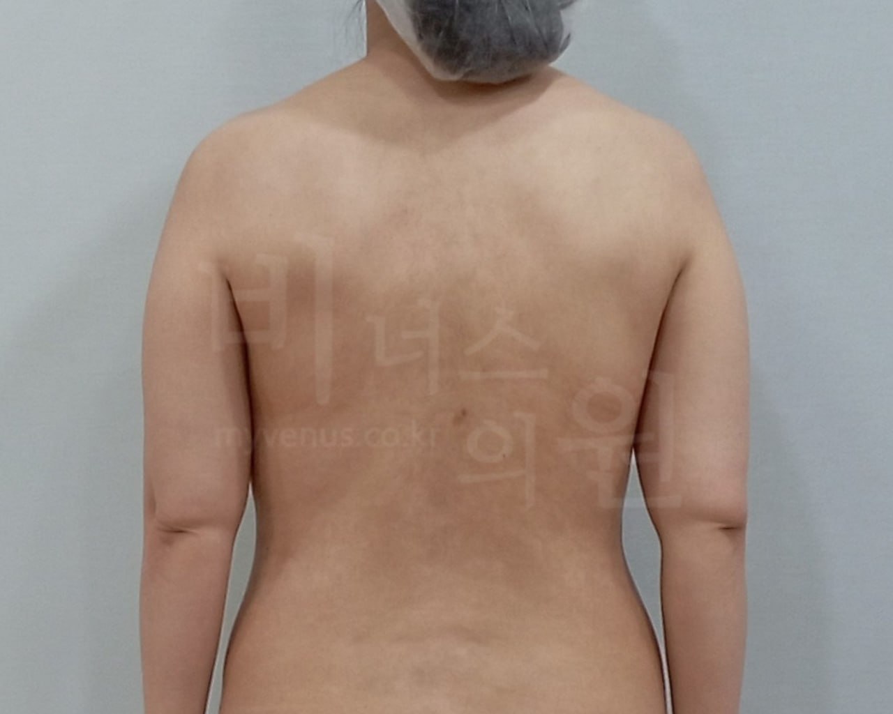 팔뚝지방흡입 수술 전 후면 팔내림 비너스의원
