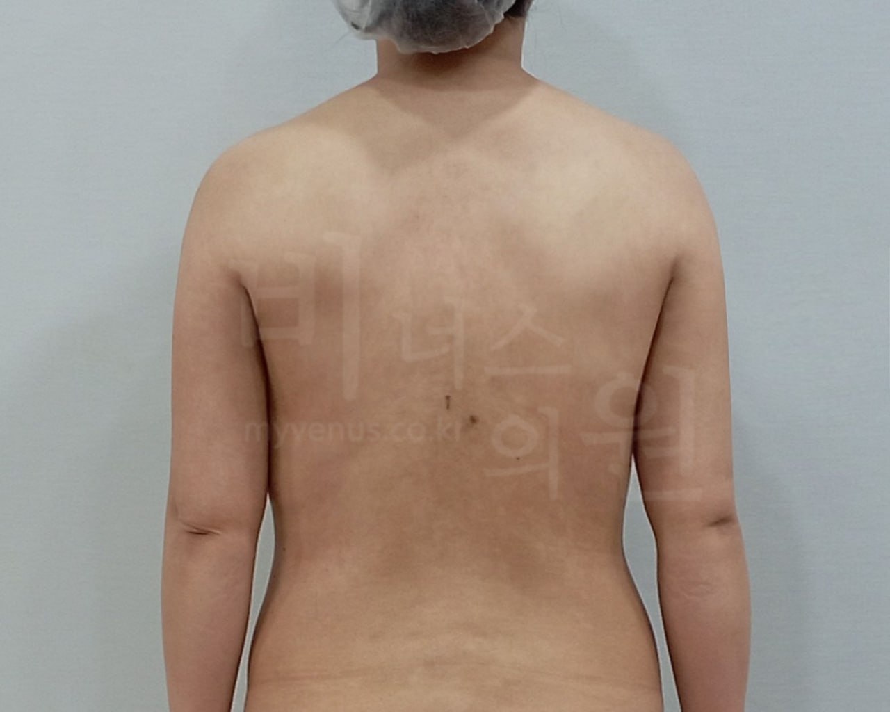 팔뚝지방흡입 수술 후 후면 팔내림 비너스의원