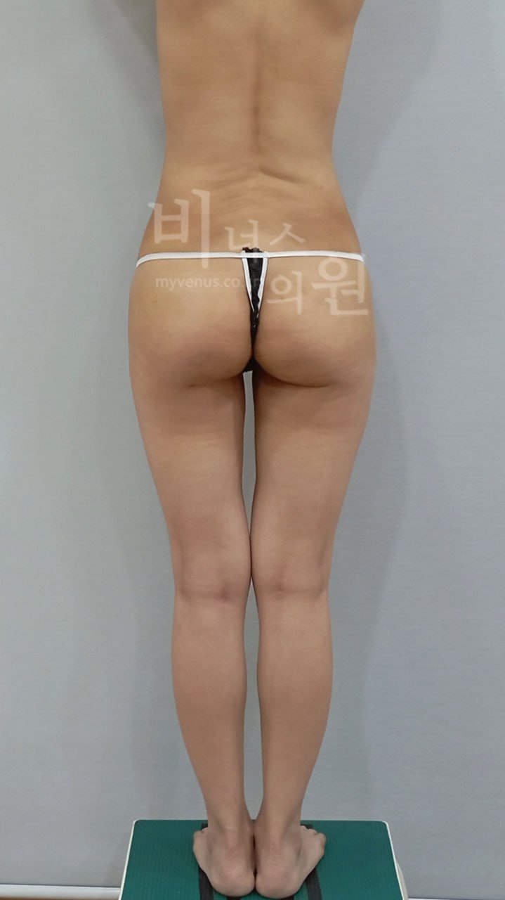 엉덩이볼륨업 지방흡입 수술 후
