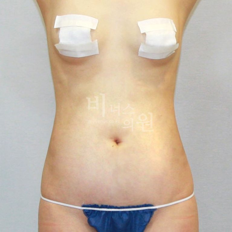 복부 지방흡입 비용과 수술 범위 — 결정 전 꼭 알아야 할 5가지 기준