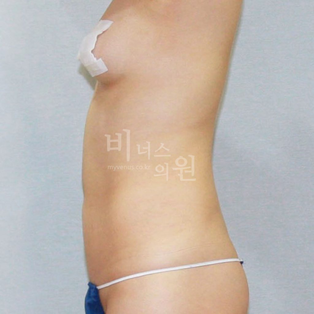 원통형 복부 지방흡입 수술 전 우측면