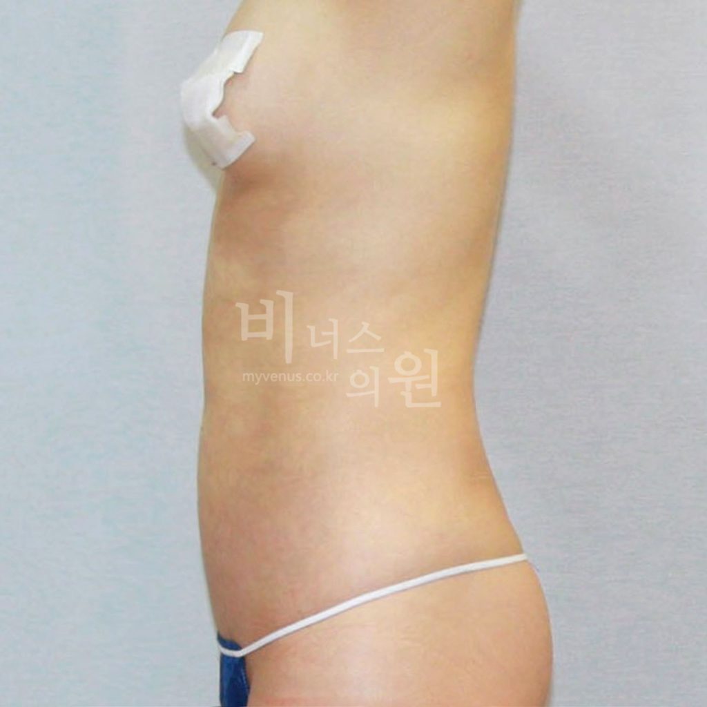 원통형 복부 지방흡입 수술 후 우측면