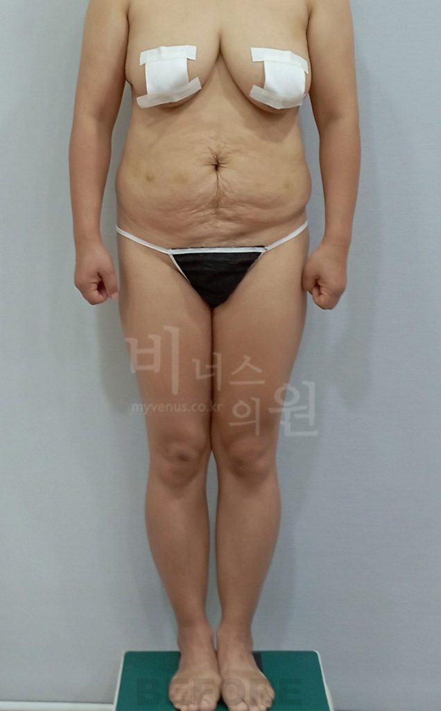 복부 엉덩이 복합 지방흡입 수술 전 정면
