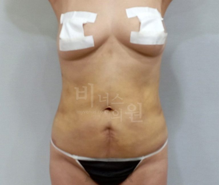 복부지방흡입 비용, 어떻게 결정될까요? 선택 전 꼭 확인하세요
