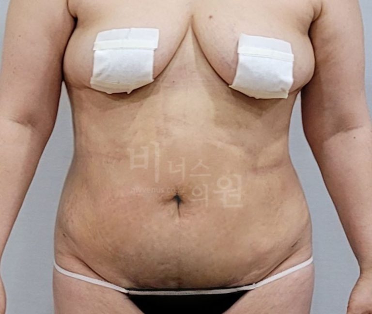 복부 지방흡입, 좋은 병원 고르는 법 — 상담 전 꼭 확인할 7가지 기준