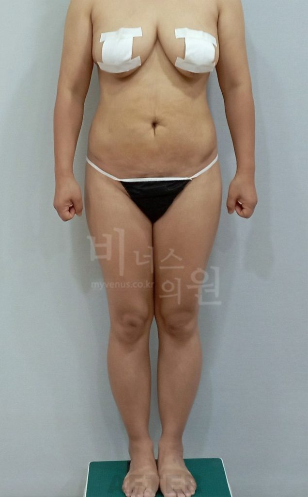 복부 엉덩이 복합 지방흡입 수술 후 정면