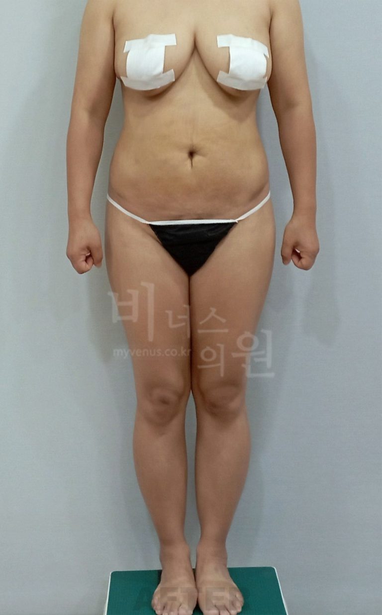 엉덩이 지방흡입 비용, 이렇게 결정됩니다 — 수술 범위별 선택 가이드