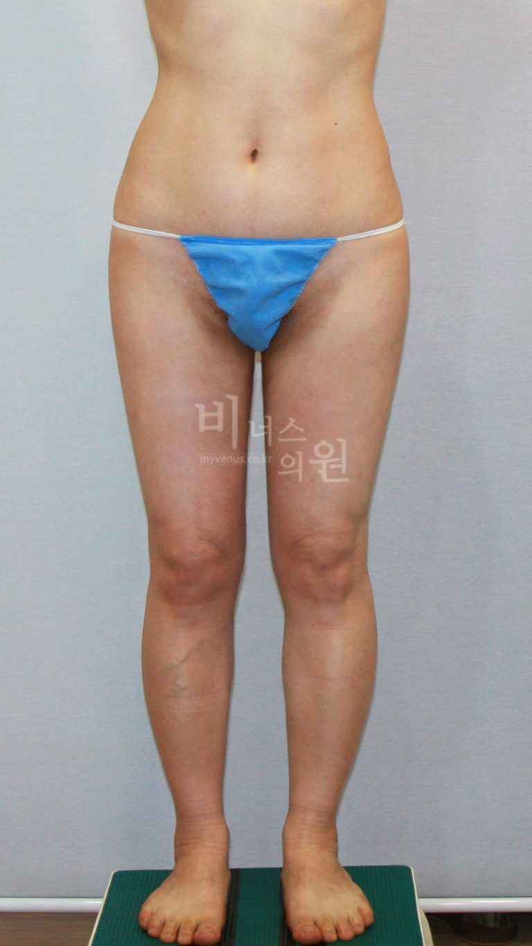 허벅지 지방흡입 맥시머(전체)와 부분 수술의 차이 — 수술 범위 결정부터 비용까지 완전 정리