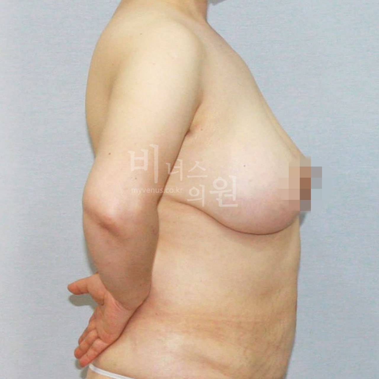 가슴 지방흡입 측면 수술 전 — 부천 비너스의원