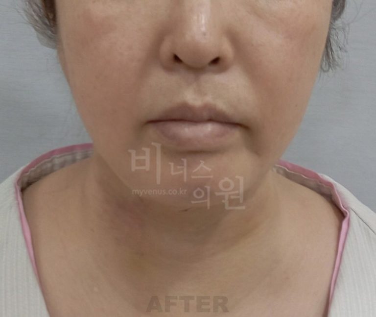 턱지방흡입 비용과 병원 선택 가이드 — 상담 전 알아야 할 체크포인트