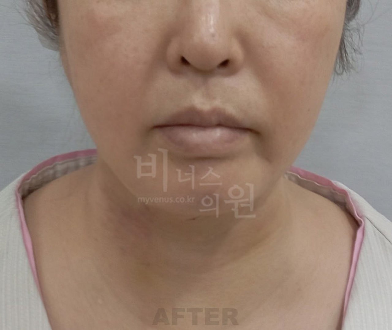 턱지방흡입 후 정면