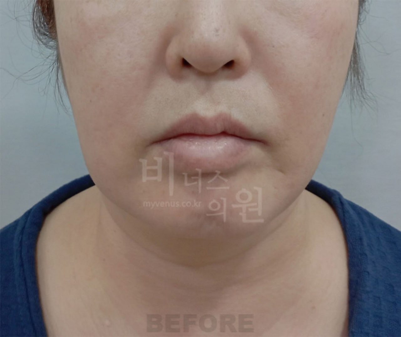 턱지방흡입 전 정면